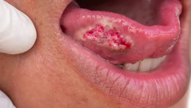 Migren Zannetti, 4. Evre Kanserle Yüzleşti: Yaşamı Değişen Kadının Hikayesi