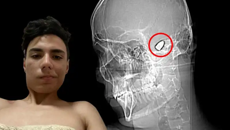 Kafasında Patlayıcı ile Yaşayan Genç, Hayat Mücadelesi Veriyor