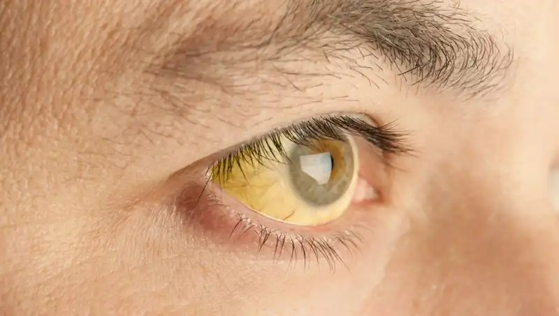 Karaciğer Sağlığınızdan Şüpheleniyor Musunuz? Gözleriniz Yanıtı Veriyor!